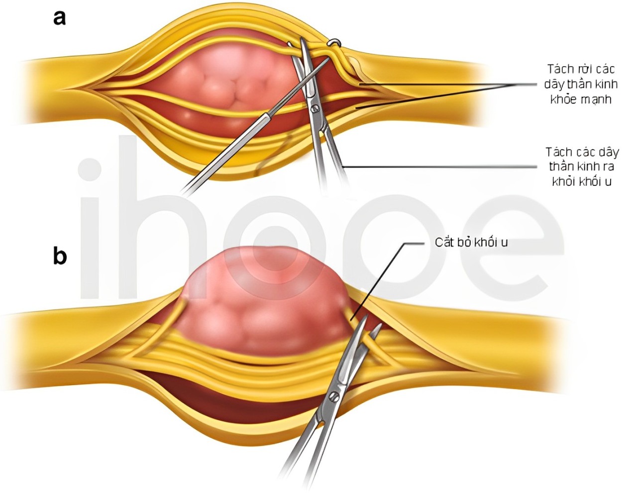 Phẫu Thuật Khối U Schwanomas 1 (1)