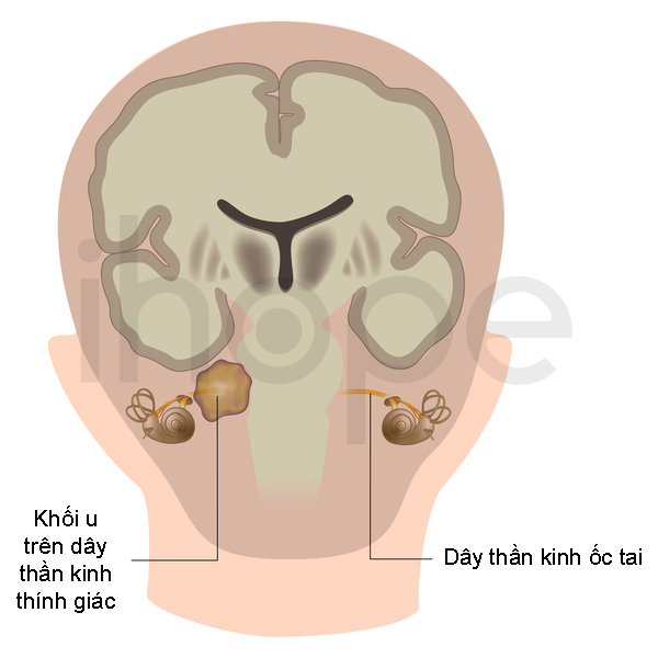 U Bao Sợi Thần Kinh Tiền đình