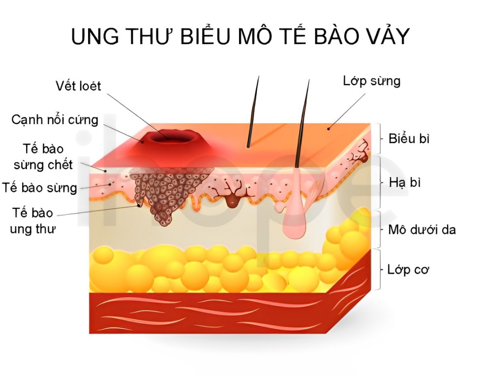 Ung Thư Biểu Mô Tế Bào Vảy