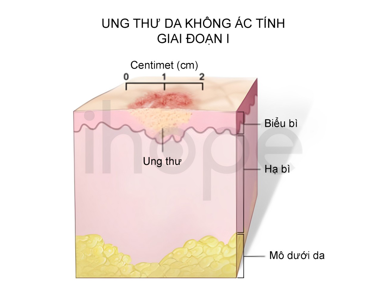 Ung Thư Da Không ác Tính Giai đoạn 1