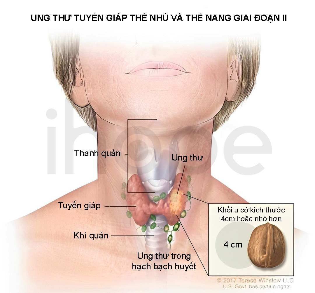 Ung Thư Tuyến Giáp (1 1)