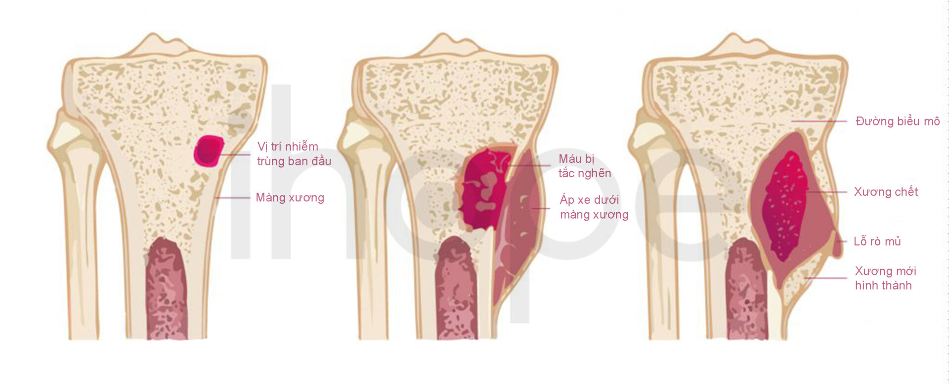 Viêm Tủy Xương Theo đường Máu