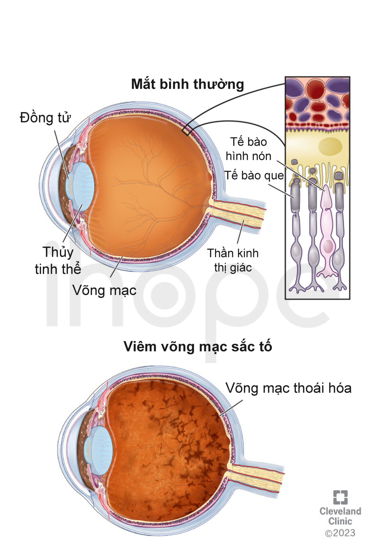 Viêm Võng Mạc Sắc Tố