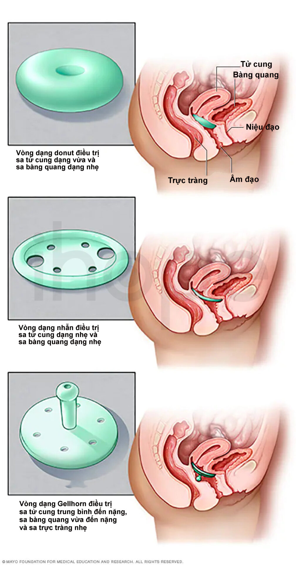 Vòng Pessary điều Trị Sa Cơ Quan Vùng Chậu