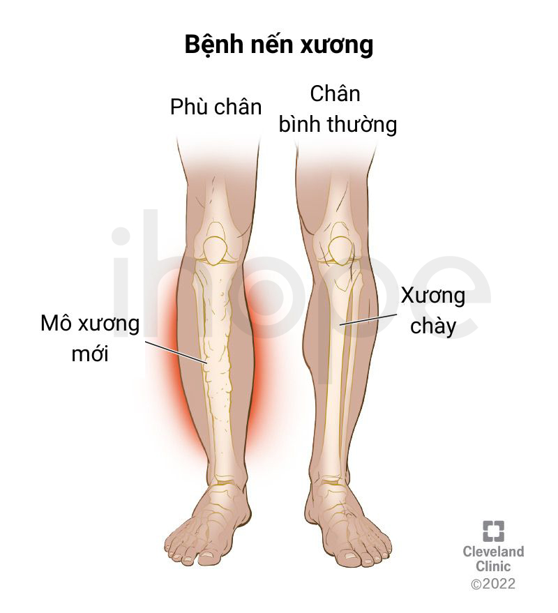 Bệnh Nến Xương 1