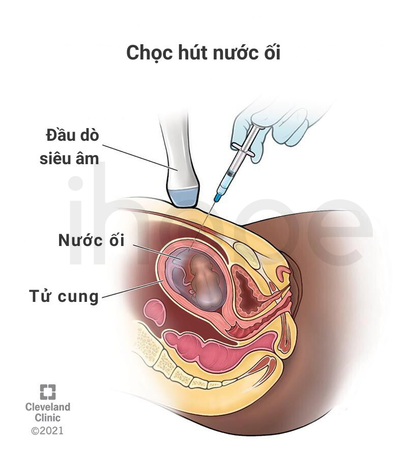 Chọc Hút Nước ối