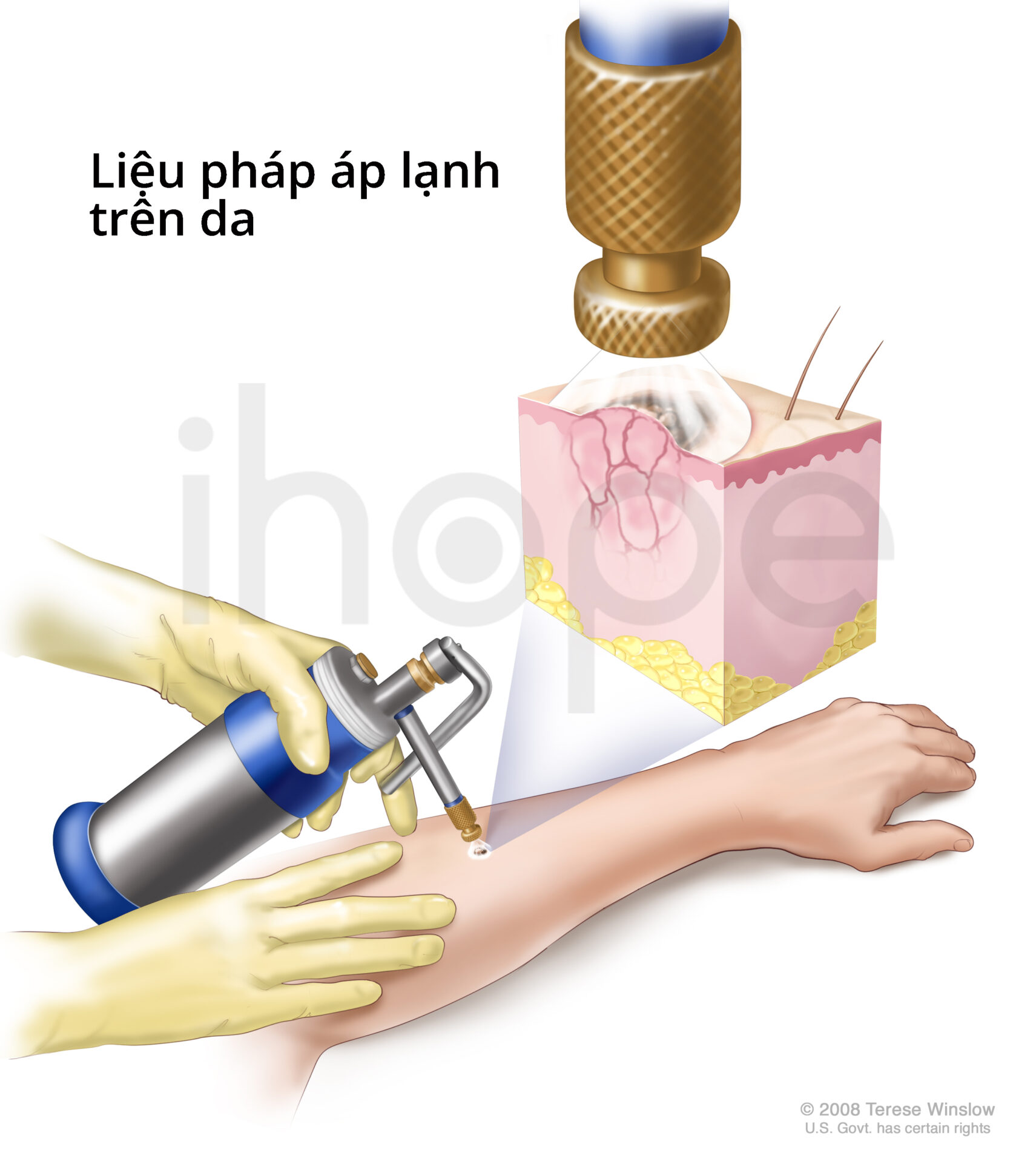 Cryosurgery