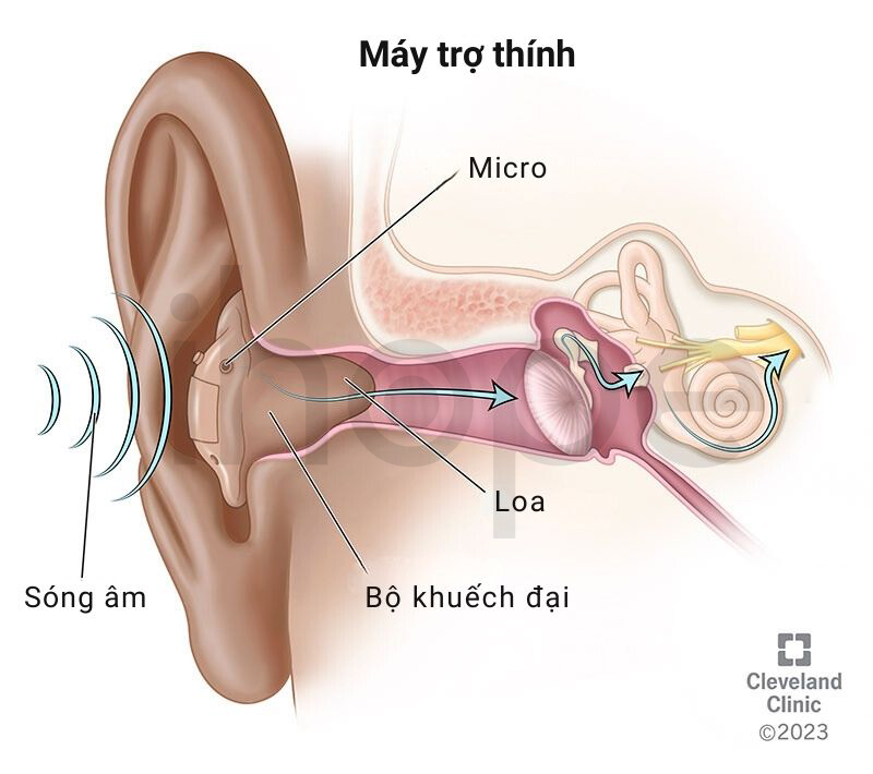 Máy Trợ Thính