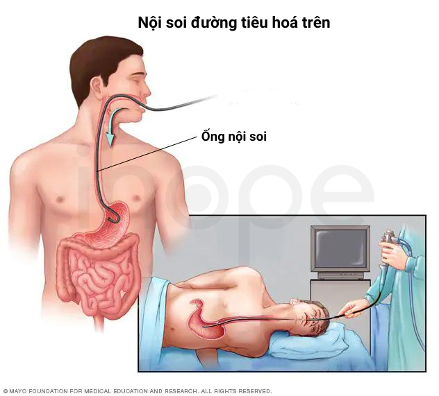Nội Soi đường Tiêu Hoá Trên