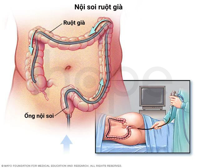 Nội Soi Ruột Già 1