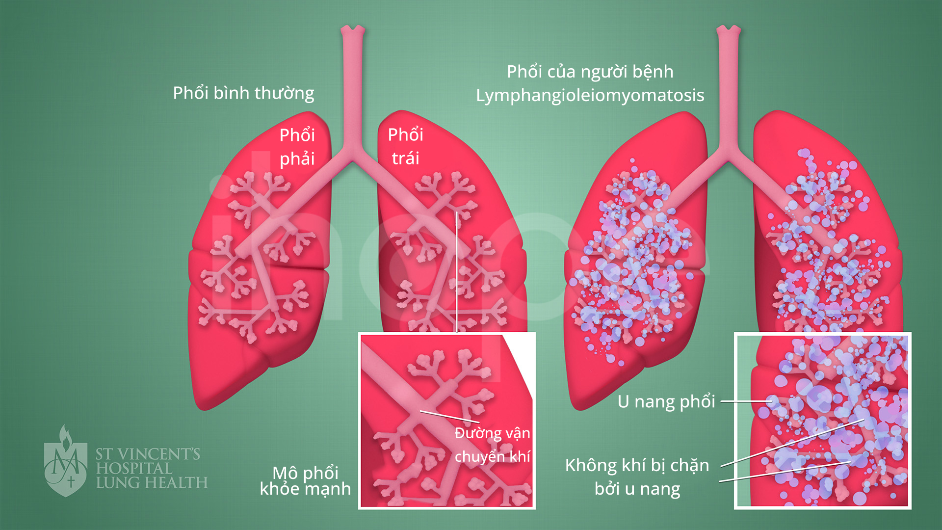 Phổi Của Người Bệnh Lam