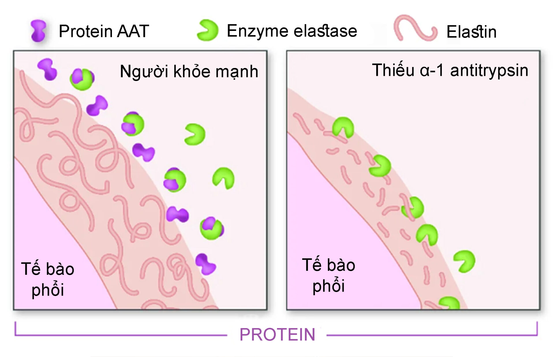 Phổi Của Người Bệnh Thiếu Alpha 1 Antitrypsin
