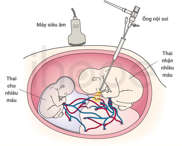 Quang động Laser Nội Soi Thai Nhi