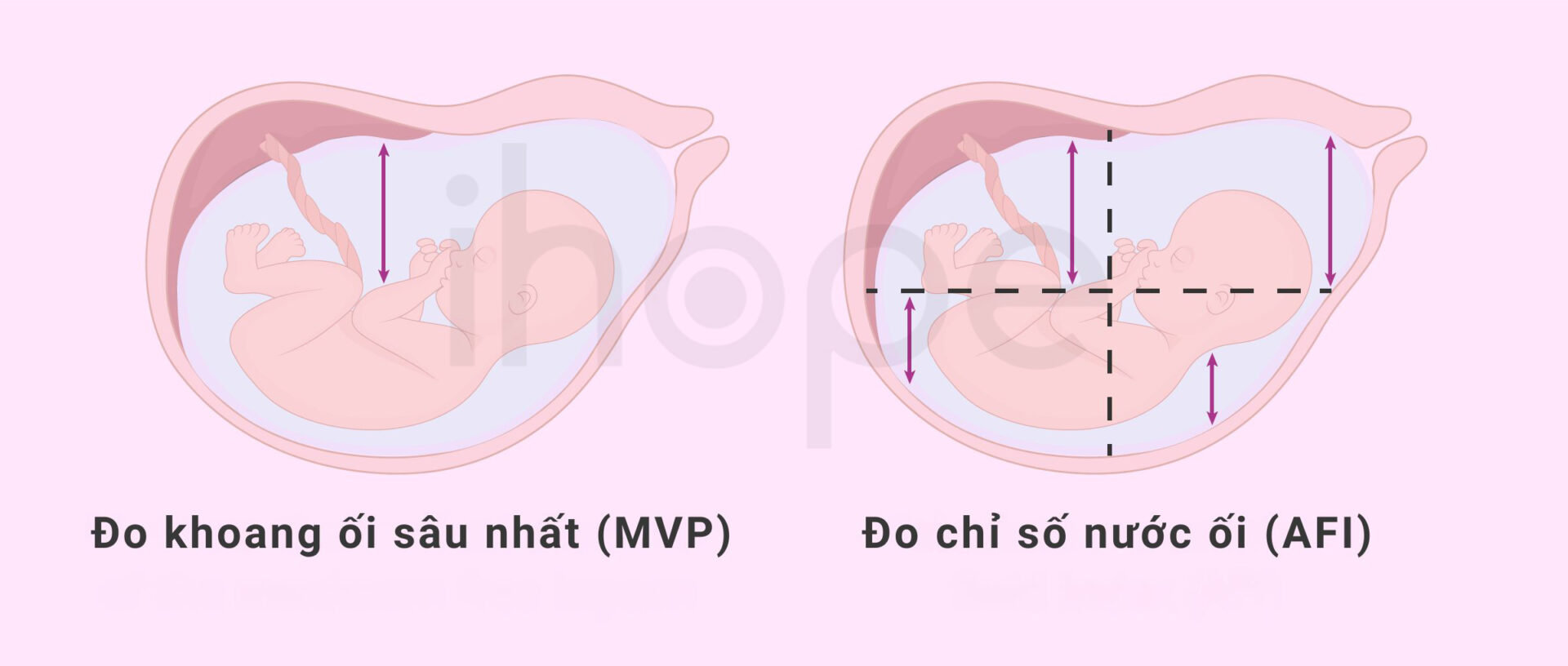 Siêu âm đo Nước ối