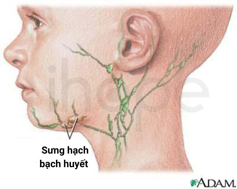 Sưng Hạch Bạch Huyết 1