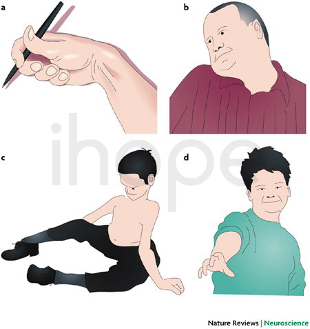 Biểu Hiện Loạn Trương Lực Cơ