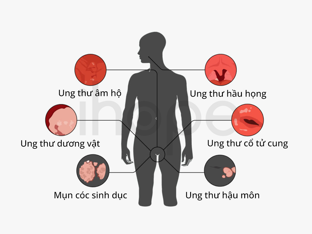 Các Loại Ung Thư Do Hpv Gây Ra