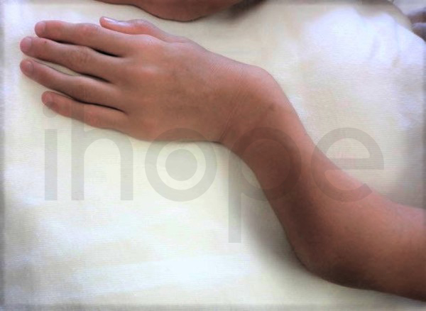 Cẳng Tay Ngắn Bất Thường