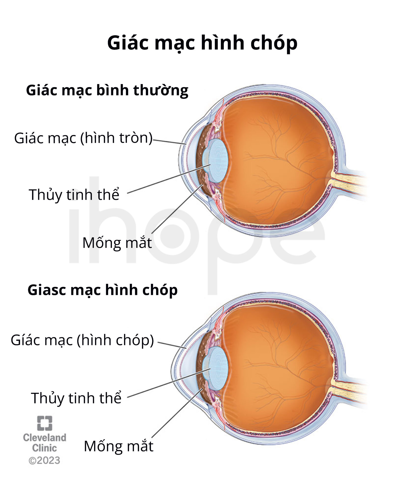 Giác Mạc Hình Chóp