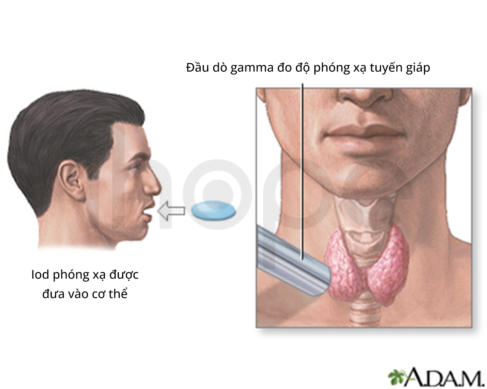 Iod Phóng Xạ
