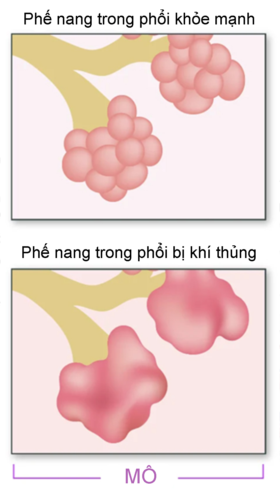 Khí Thủng Phổi