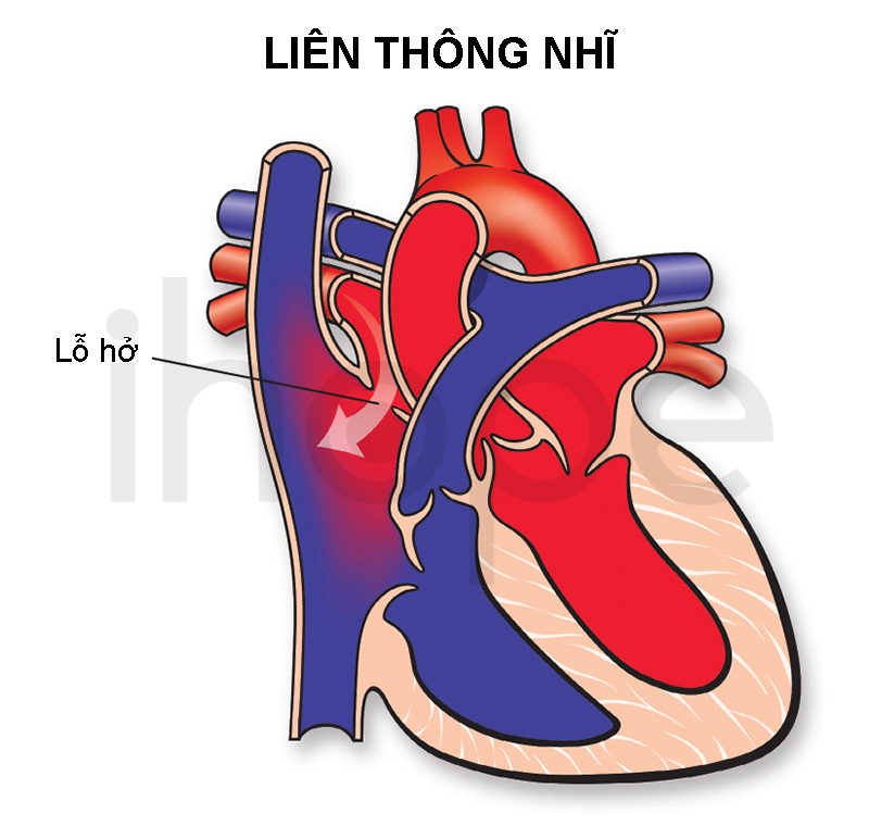Liên Thông Nhĩ