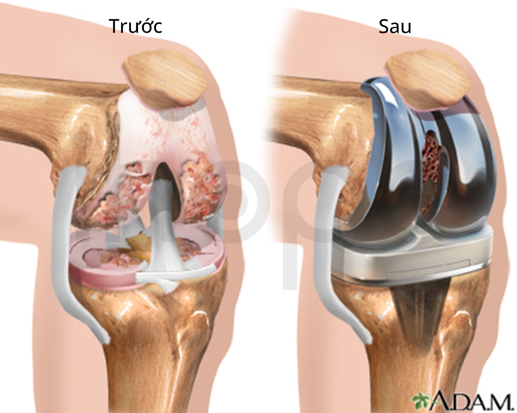 Phẫu Thuật Thay Khớp