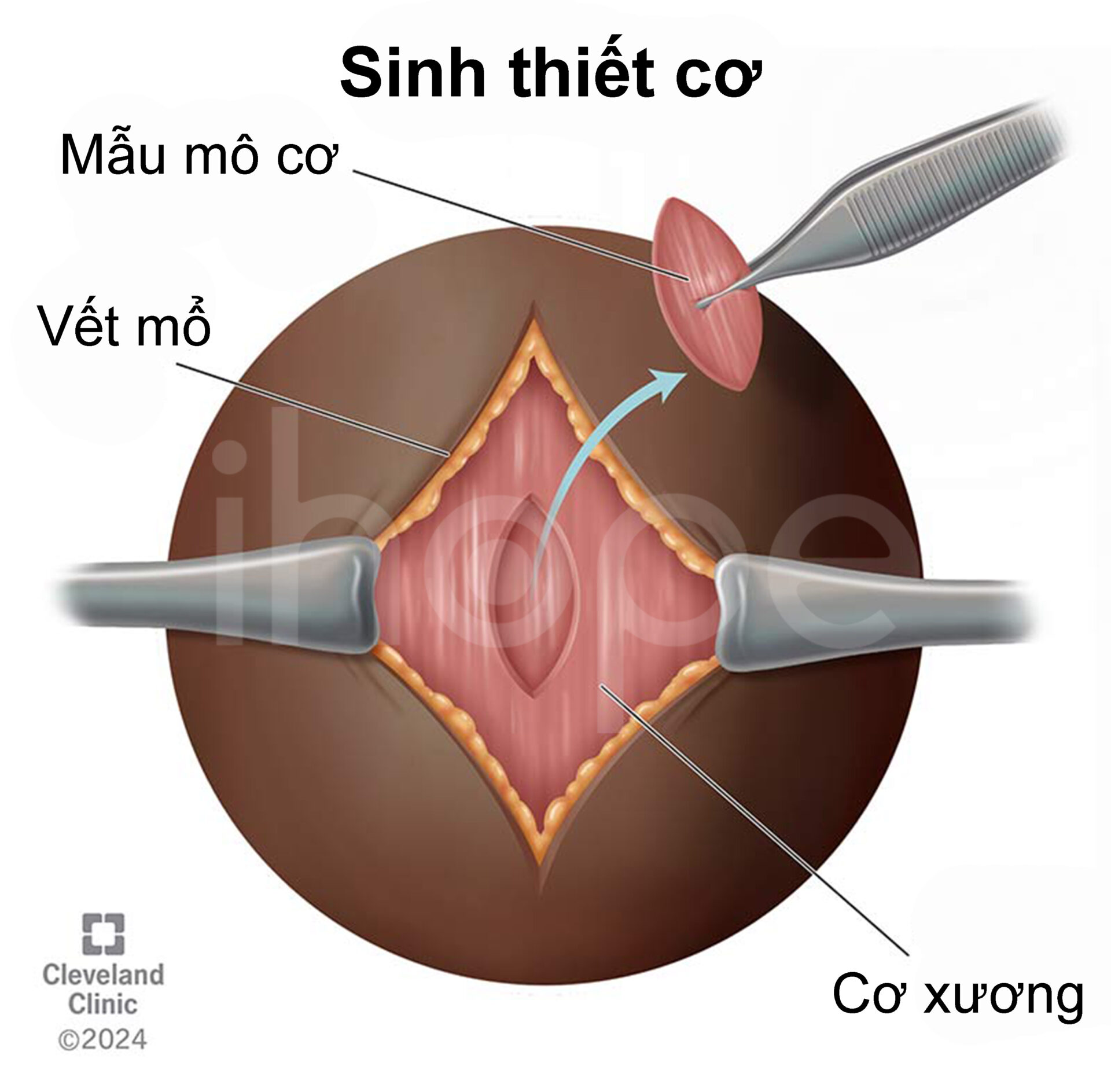 Sinh Thiết Cơ
