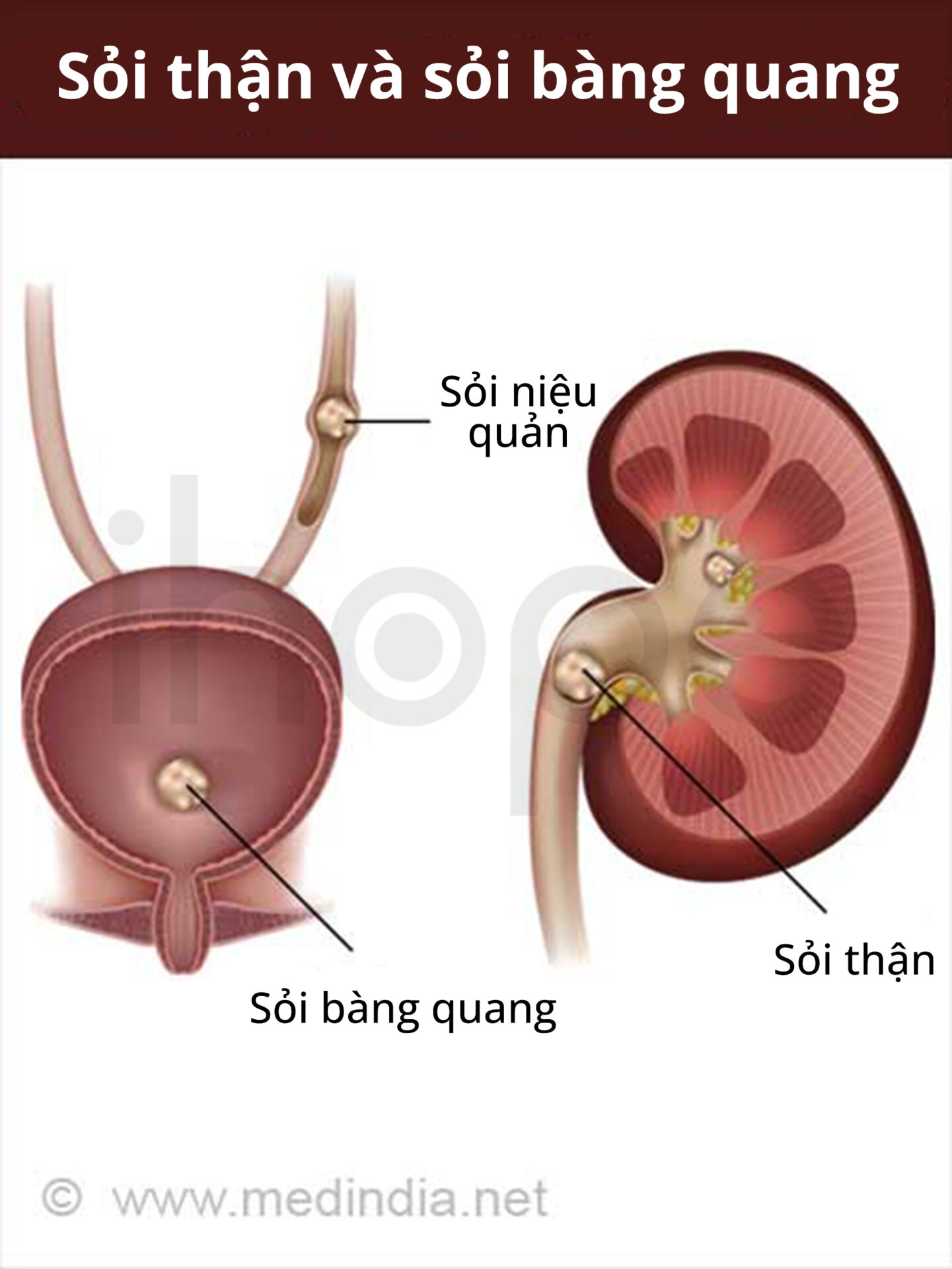 Sỏi Thận Và Sỏi Bàng Quang