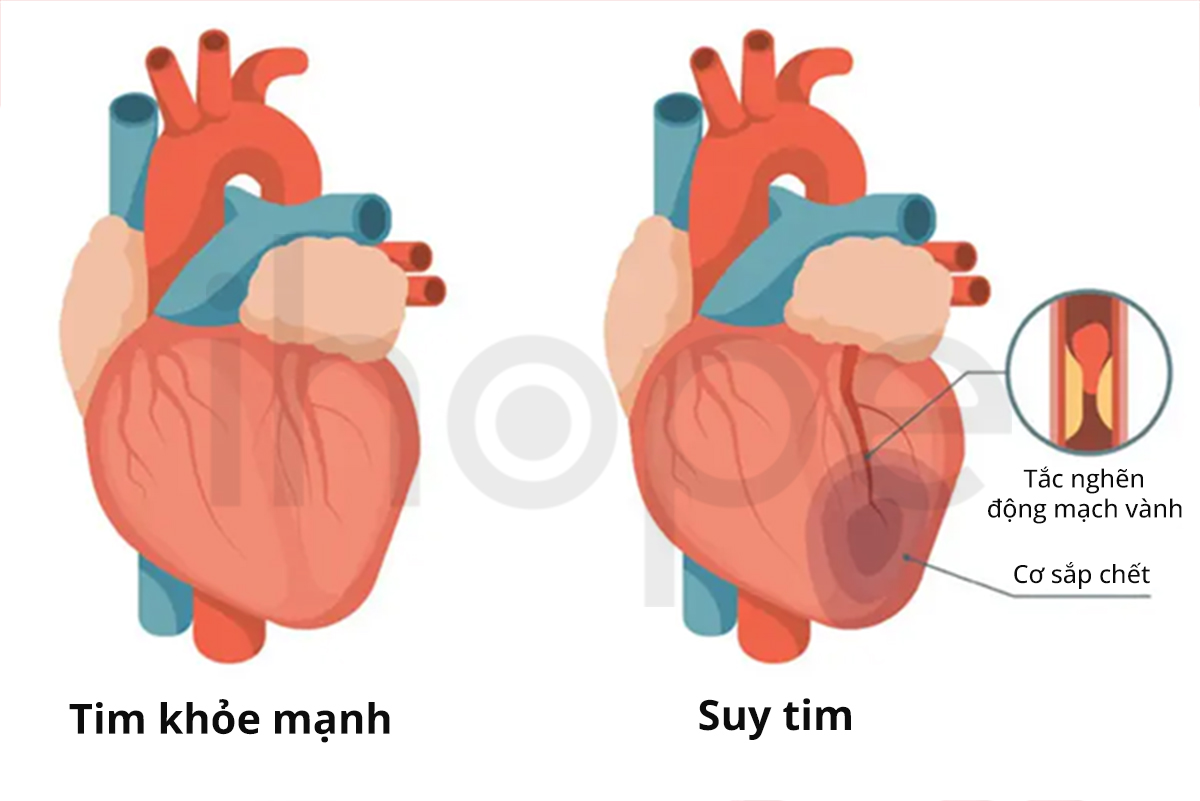 Suy Tim