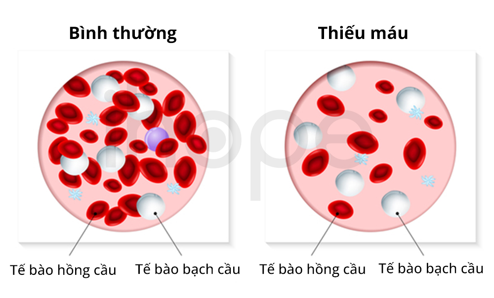 Thiếu Máu