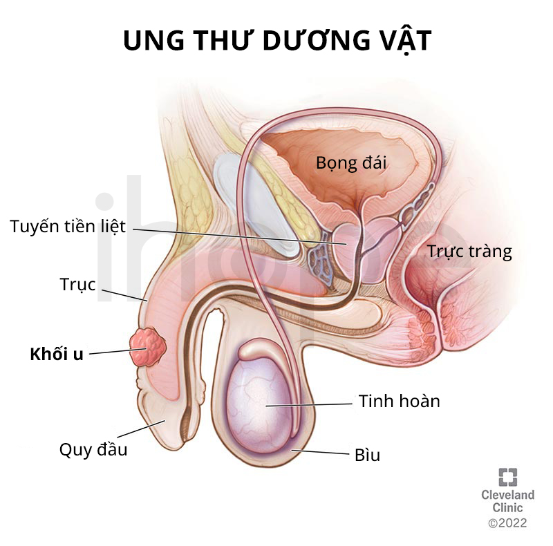 Ung Thư Dương Vật