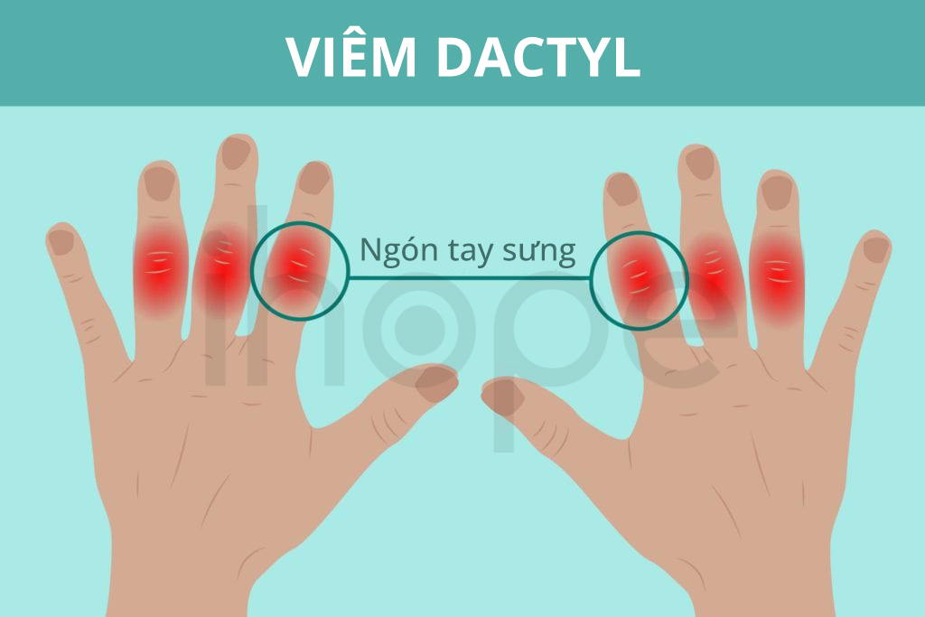Viêm Dactyl