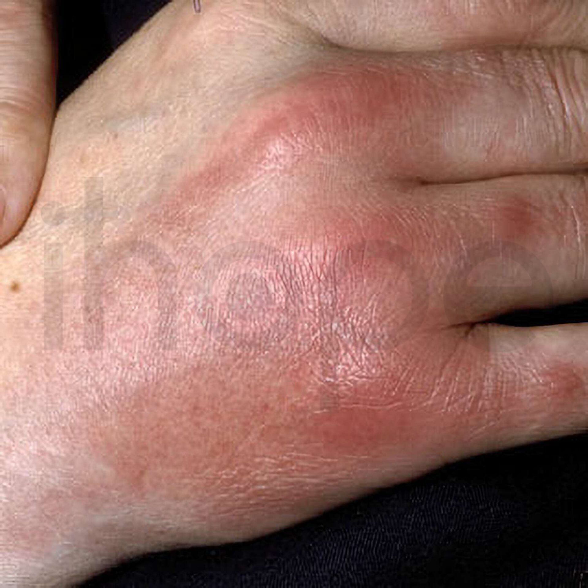 Viêm Mô Mỡ Dưới Da