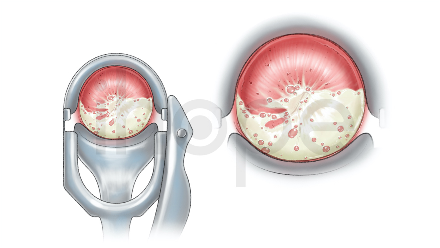 Khí Hư Cổ Tử Cung Do Trichomonas