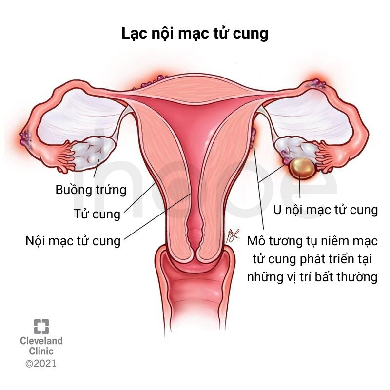 Lạc Nội Mạc Tử Cung 1