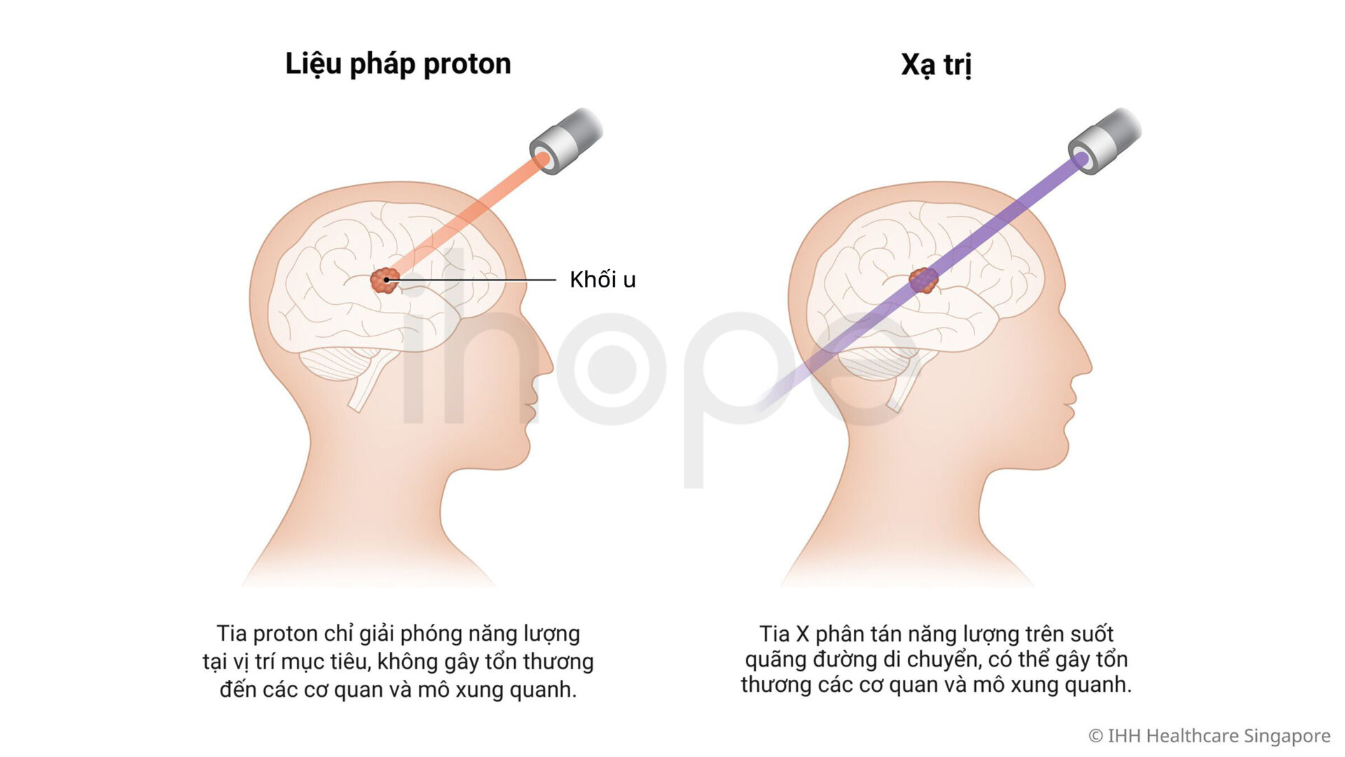 Liệu Pháp Proton Và Xạ Trị 1