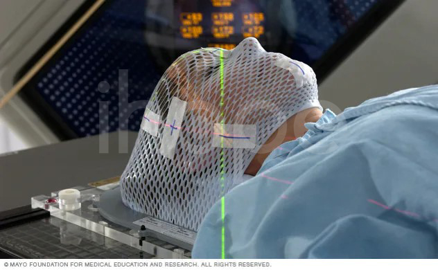 Mặt Nạ Trong Phương Pháp Xạ Phẫu định Vị Bằng Máy Linac