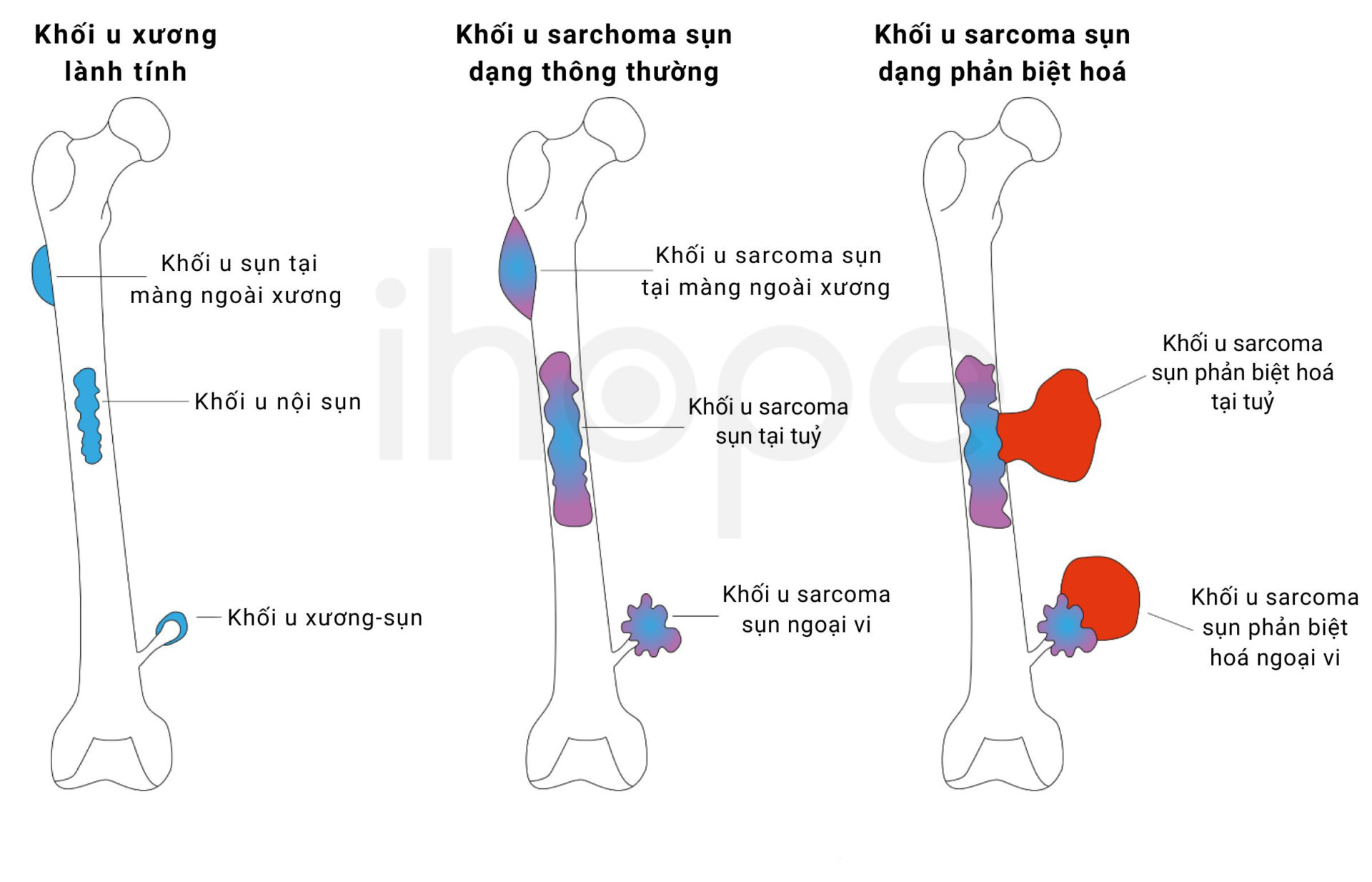 Các Dạng Khối U Sarcoma Sụn 1