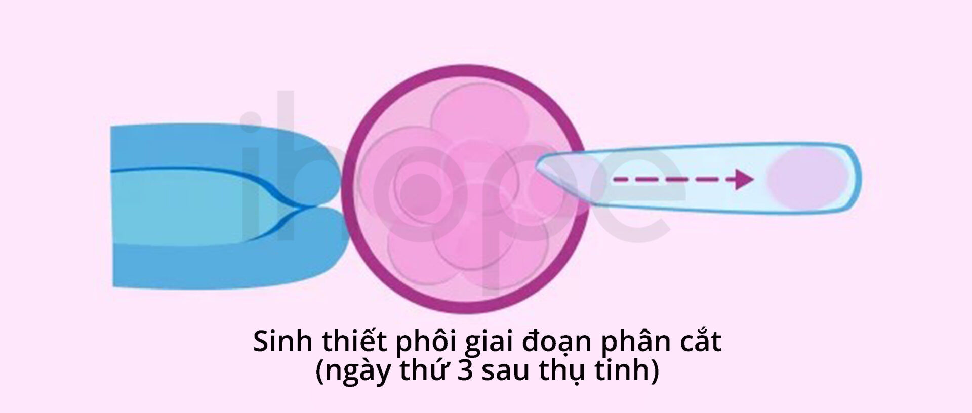 Sinh Thiết Phôi Giai đoạn Phân Cắt