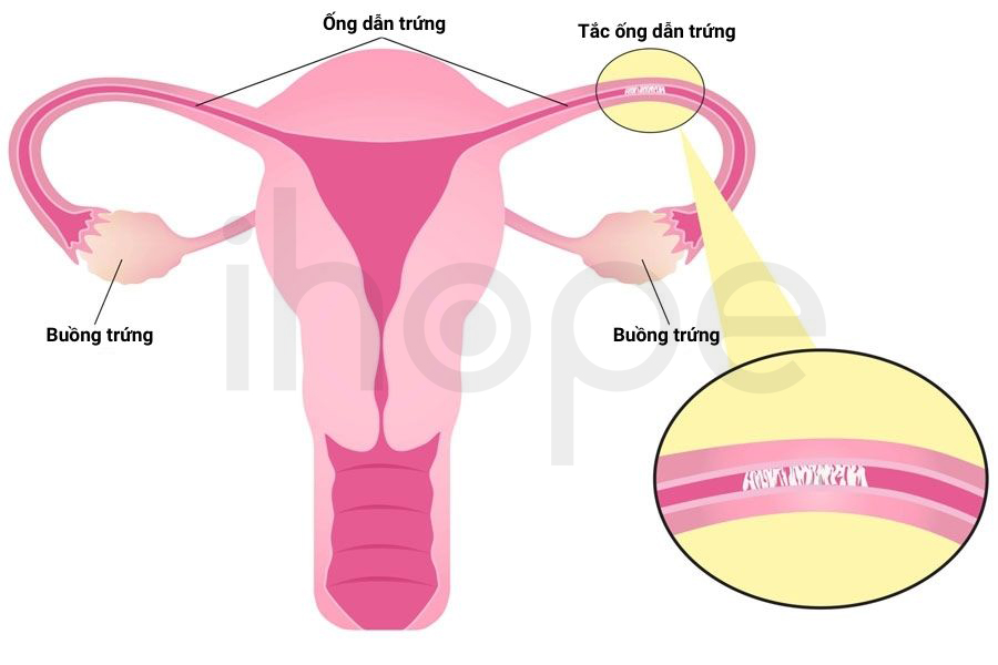 Tắc ống Dẫn Trứng 1