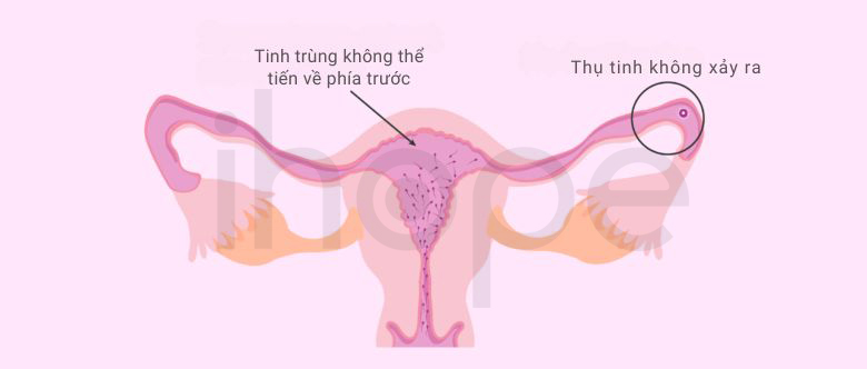 Tinh Trùng Mất Khả Năng Di Chuyển 1