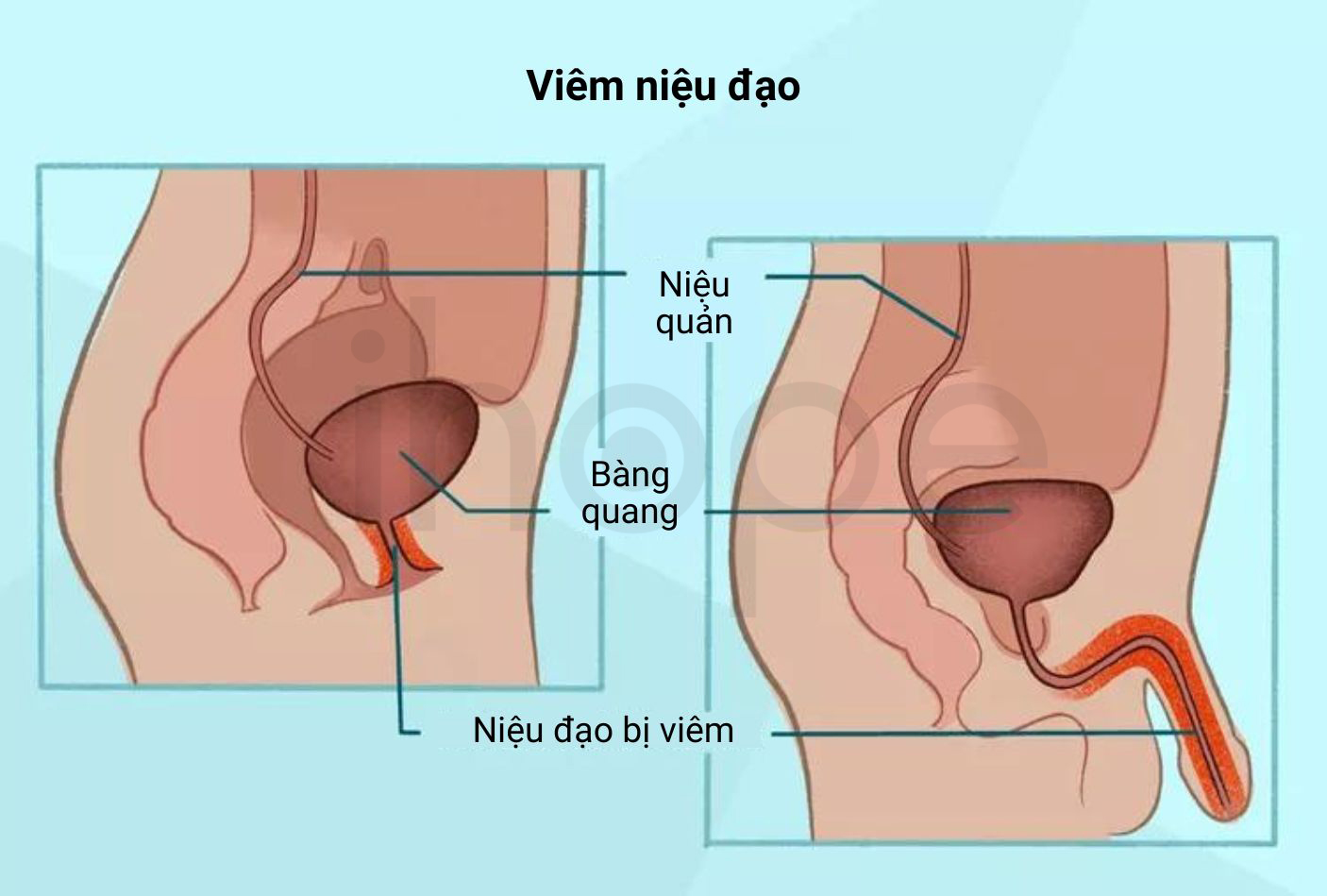 Viêm Niệu đạo 1