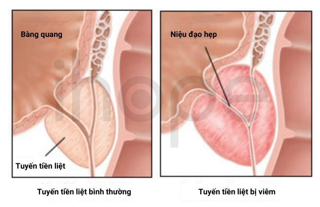 Viêm Tuyến Tiền Liệt 1