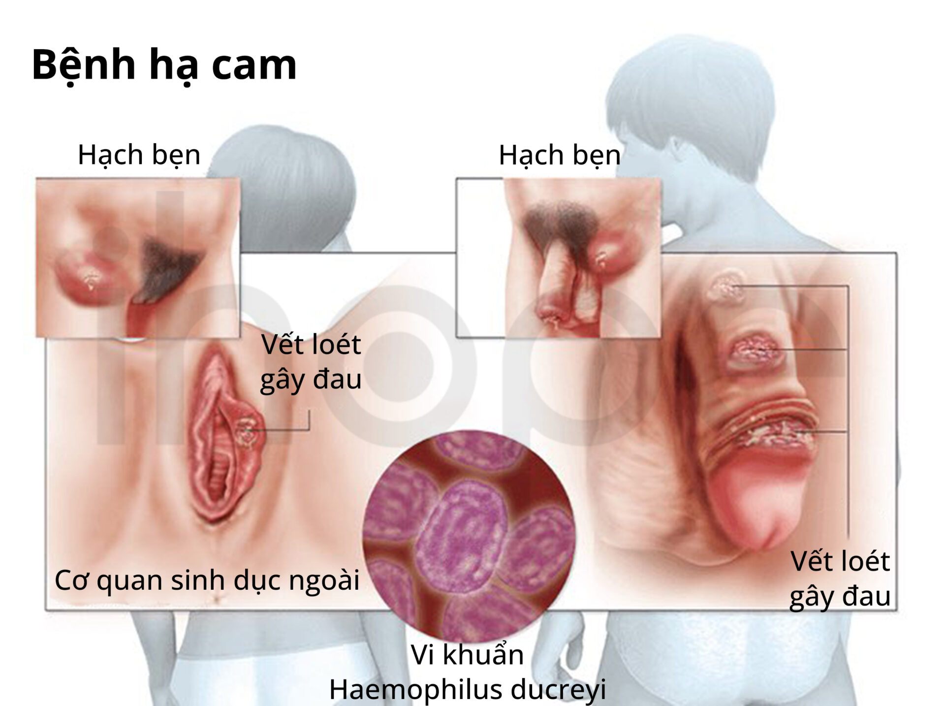 Biểu Hiện Bệnh Hạ Cam