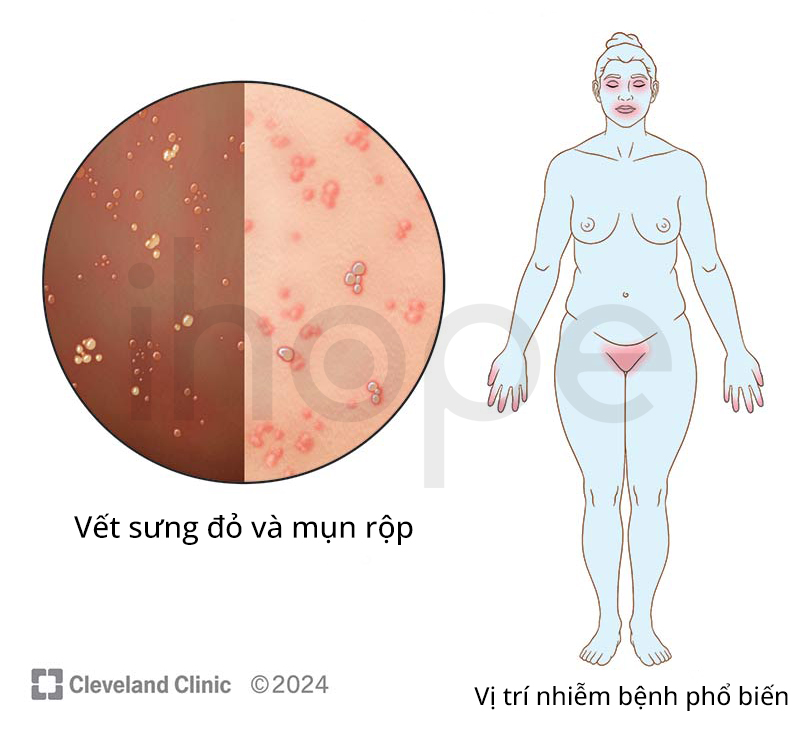 Các Vị Trí Nhiễm Virus Herpes Simplex Phổ Biến