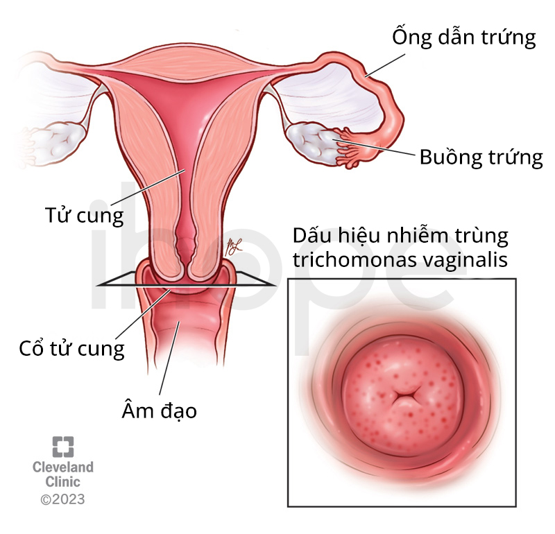 Dấu Hiệu Nhiễm Trùng Trichomonas Vaginalis