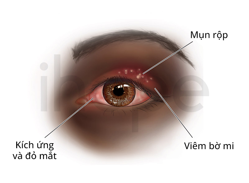 Herpes Mắt