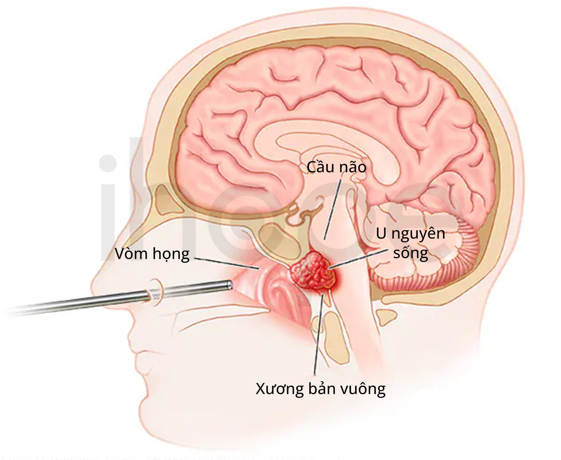 Phẫu Thuật Nội Soi Nền Sọ
