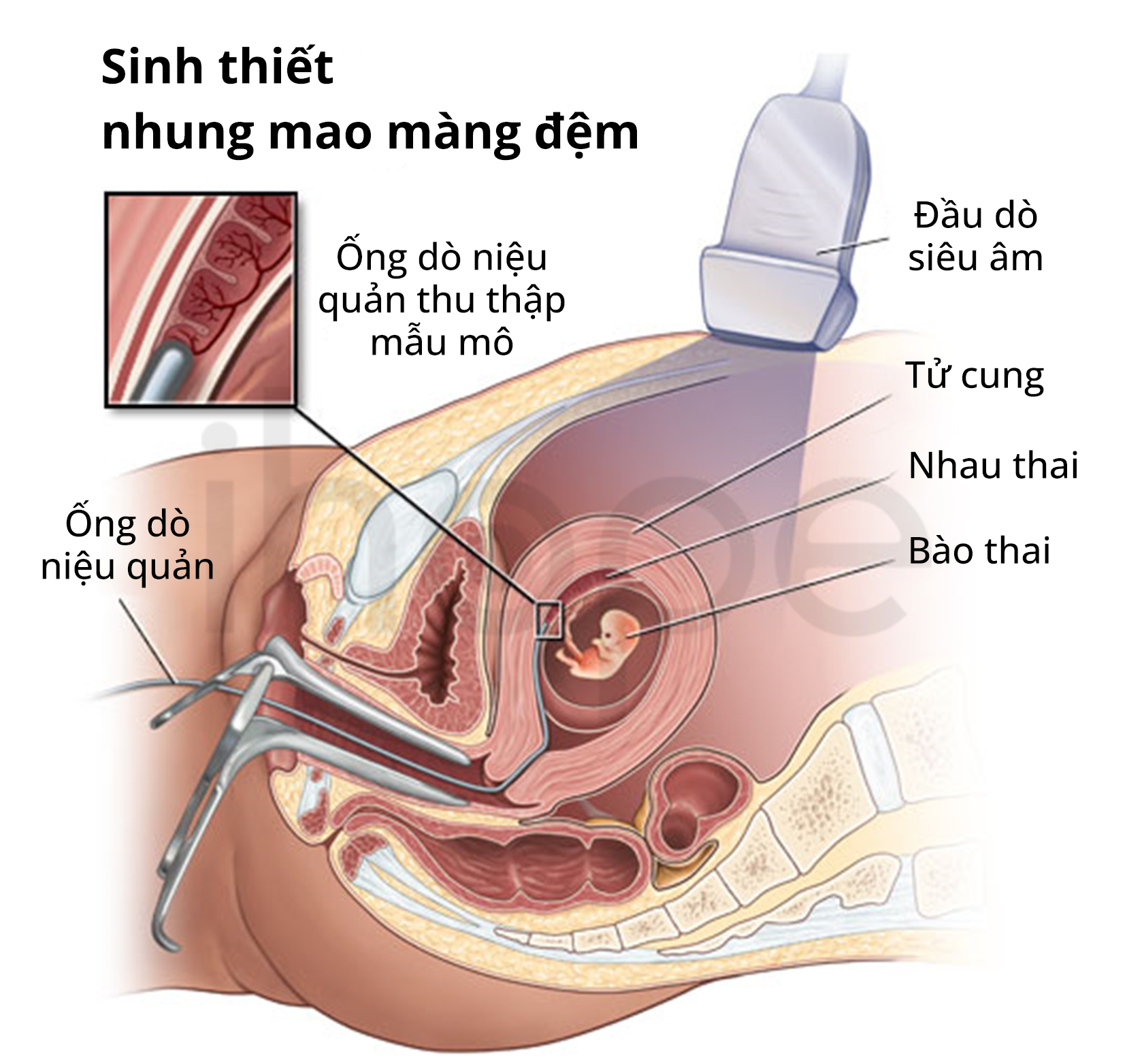 Sinh Thiết Nhung Mao Màng đệm